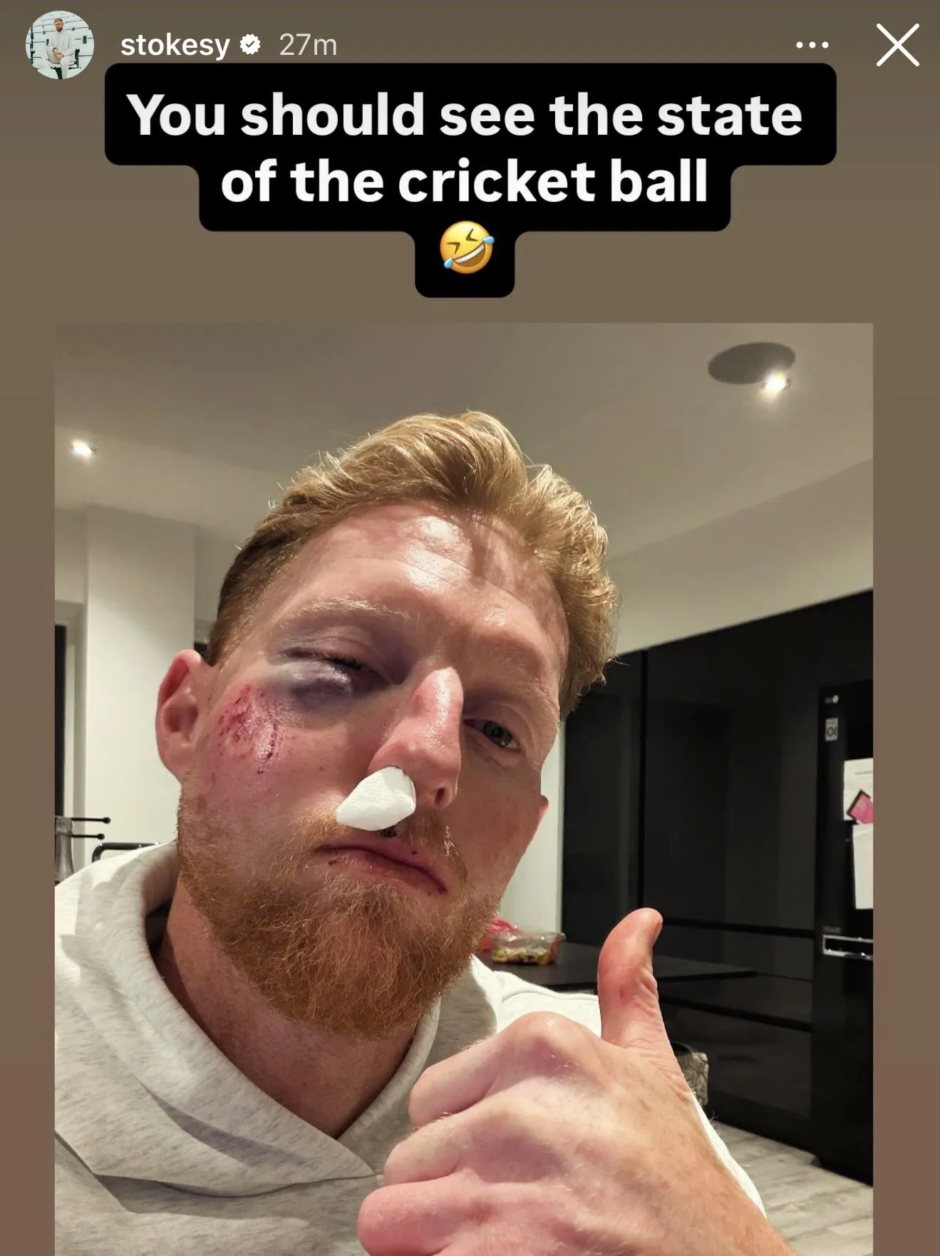 stokes-injured-face-20260206130328